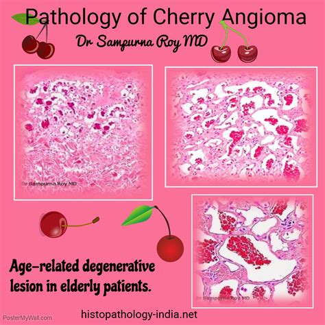 These spots can occur with greater frequency as individuals get older, sometimes leading people to call them senile angioma. Pathology of Cherry Angioma - (Senile Angioma ; Campbell ...