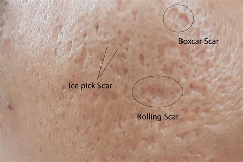Ice Pick Scar Treatments Core Plastic Surgery