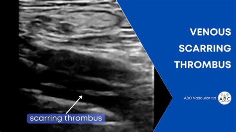 Scarring Thrombus Of The Femoral Veins After Deep Vein Thrombosis