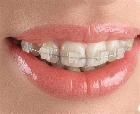 The Benefits Of Buying A Teeth Braces In Fort Walton Beach Copsctenerife
