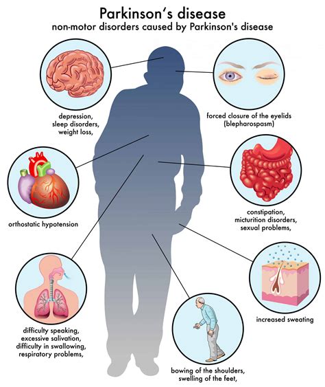 Parkinson S Disease Hohman Rehab And Sports Therapy