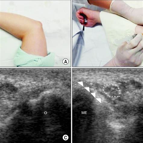Pdf Clinical Implications Of Real Time Visualized Ultrasound Guided