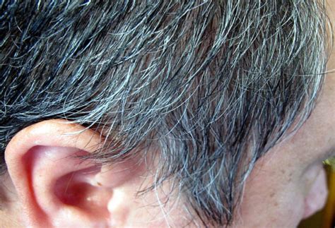 What Causes Premature Graying In Hair Short Hills Dermatology
