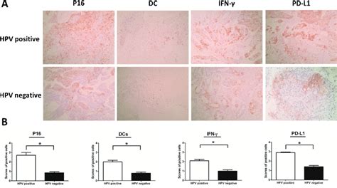 Expression Of P16 Dc Sign Ifn γ And Pd L1 Positive Cells Were