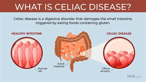 The Doctors 101 Chronic Symptoms And Conditions 43 Celiac Disease