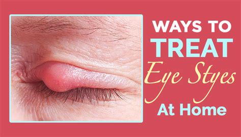 Ways To Treat Eye Styes At Home Htv