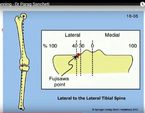 High Tibial Osteotomy Planning And Indications —