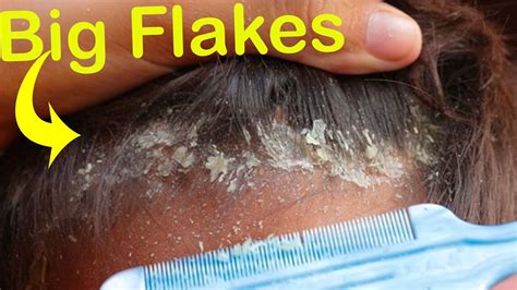 Big Flakes Dry Flaky Scalp Dandruff Scratching 75 Youtube