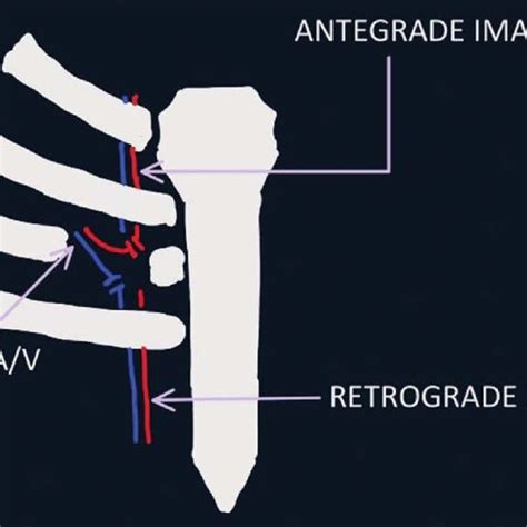 Bipedicled Deep Inferior Epigastric Artery Perforator Flap Download