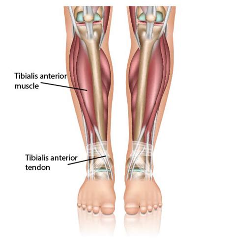 Tibialis Anterior Tendonitis