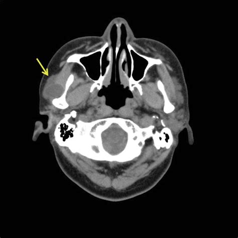 Salivary Duct Cyst Of Accessory Parotid Gland In Contact With The