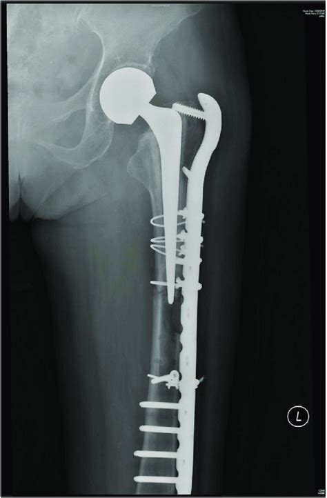 Revision Fixation With Pre Contoured Long Spanning Femur Locking Plate