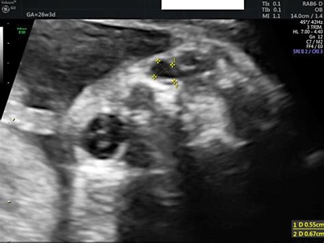 Two Dimensional Ultrasound Demonstrating A Cystic Lesion In The Right