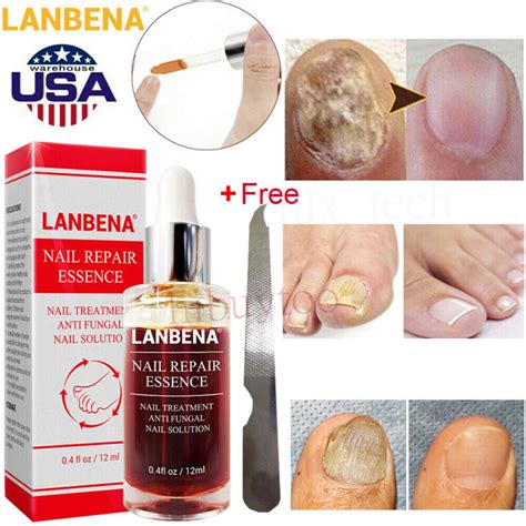 Lanbena Anti Fungal Nail Treatment Finger Toe Care Nail Fungus