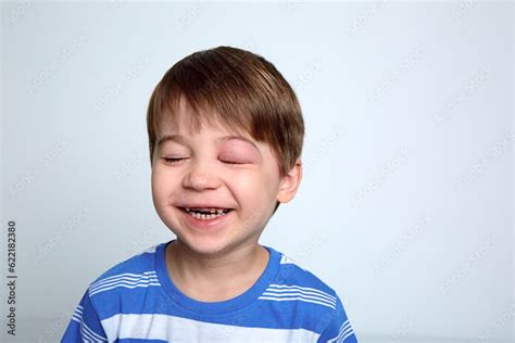 Child With Swollen Eye From Insect Bite Face Of Allergic Person