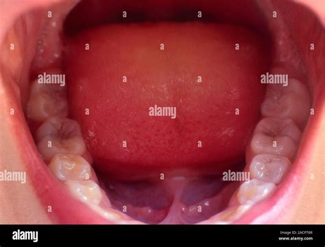 Childs Molars And Tongue View Of A 12 Year Old Girls Lower Teeth And