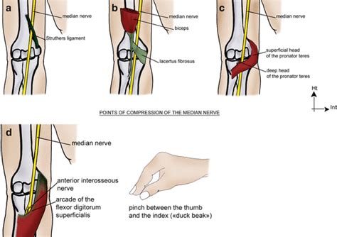 Entrapment Syndromes Of The Median Nerve Springerlink