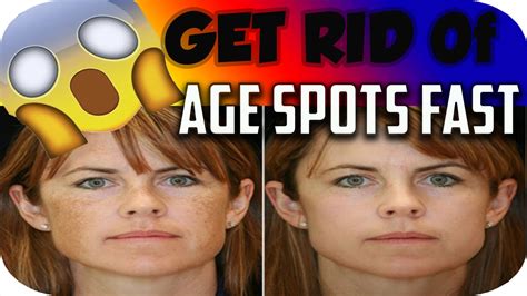 How To Get Rid Of Age Spots Remove Age Spots Youtube