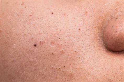 What Is The Difference Between Clogged Pores And Acne
