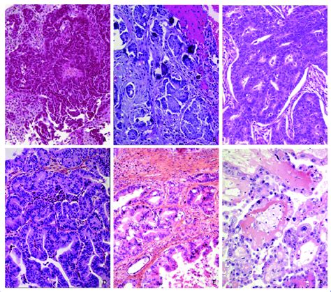 Histopathology Of Ovarian Epithelial Tumors A High Grade Serous Download Scientific Diagram