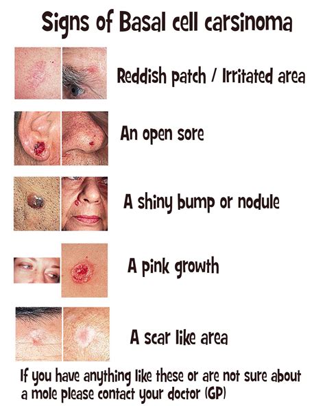 The characteristics and location of basal cell carcinoma vary somewhat with the type, although many are a mixture of types. What Does Basal Cell Skin Cancer Look Like? - Expert ...