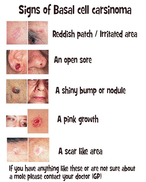However, some people develop symptoms where they have this skin cancer. What Does Basal Cell Skin Cancer Look Like? - Expert ...