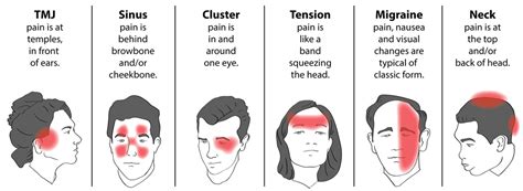 Types Of Headaches At Back Of Head Rhonda Carlton Bruidstaart
