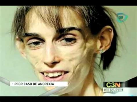 Anorexia ✓ te explicamos qué es la anorexia, cuáles son sus síntomas, causas y consecuencias. El peor caso de anorexia - YouTube