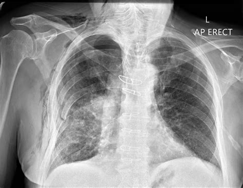 Pneumothorax Chest X Ray Medschool