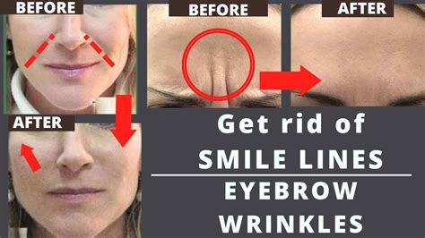 Face Lifting How To Remove Smile Lines Nasolabial Folds Eyebrow