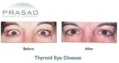 Thyroid Eye Disease Graves Disease Prasad Cosmetic Surgery Ny