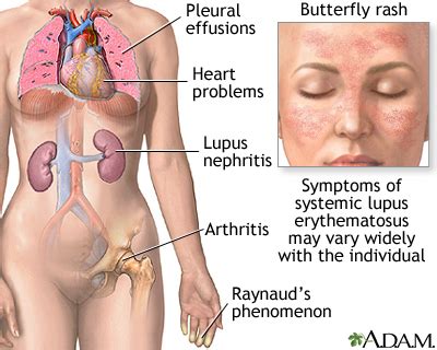 Systemic Lupus Erythematosus Medlineplus Medical Encyclopedia Image