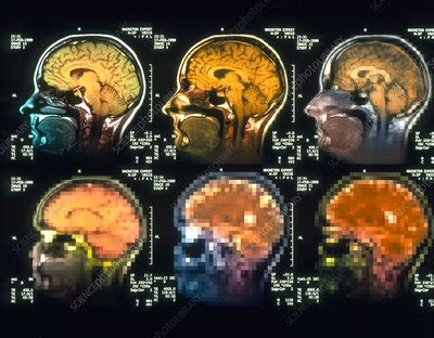 Conceptual Mri Scans Of A Brain Disorder Stock Image P Science Photo Library