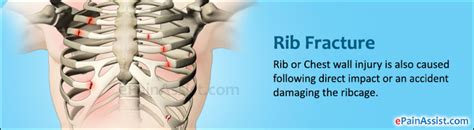 Rib Fracture Or Broken Ribcausessymptomsdiagnosistreatment Ice Nsaids