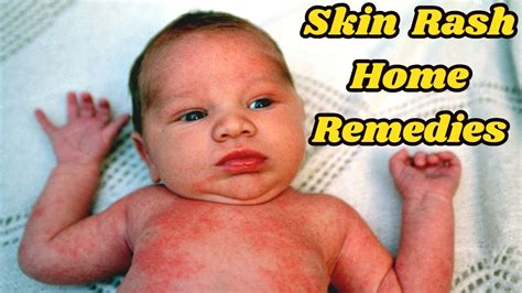 5 Simple Home Remedies For Rash On Your Babys Body Naturalremedies