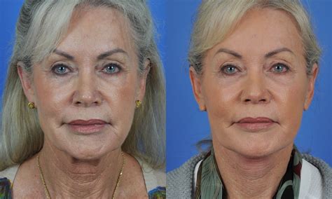Case Study For Face And Neck Lift In San Diego Ca