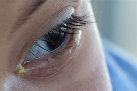 Crusty Eyes In The Morning Causes And Treatment