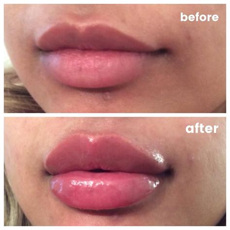 Pin By Bernice Lawlor On Makeup Lip Injections Lip Fillers Lip