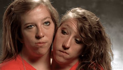 These Conjoined Twins Are Amazing Us Once Again Ninjajournalist