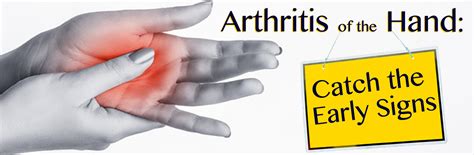 Arthritis Of The Hand In Louisiana Catch The Early Signs Anonpr