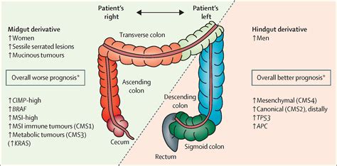 Colorectal Cancer The Lancet