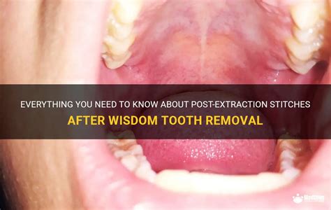 Everything You Need To Know About Post Extraction Stitches After Wisdom