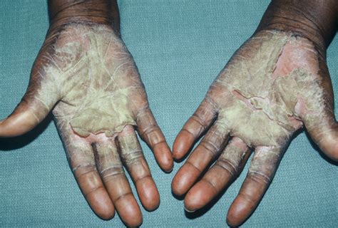 Blister On Palm Of Hand Treatment Mldesignstoronto