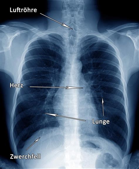 Röntgen Thorax Lunge Gründe Ablauf Bilder praktischArzt