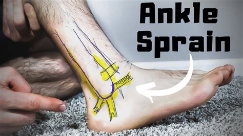 Twisted Or Rolled Ankle Sprain Treatment Faster Home Recovery Time