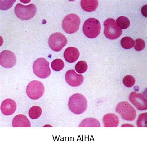 Anemia Of Chronic Disease And Hemolytic Anemia I3010 Flashcards Quizlet