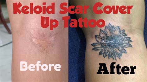 Sun Flower Keloid Scar Cover Up Tattoo My First Tattoo Experience Busy