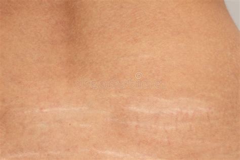Stretch Marks On The Lower Back Stock Image Image Of Loss Human