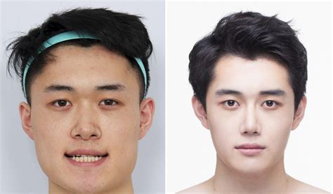 Kpop Plastic Surgery Before And After