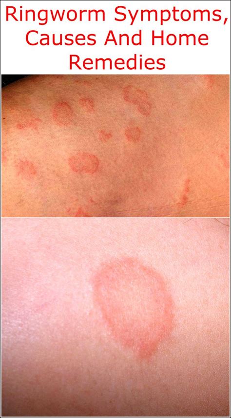 What Is Ringworm Symptoms